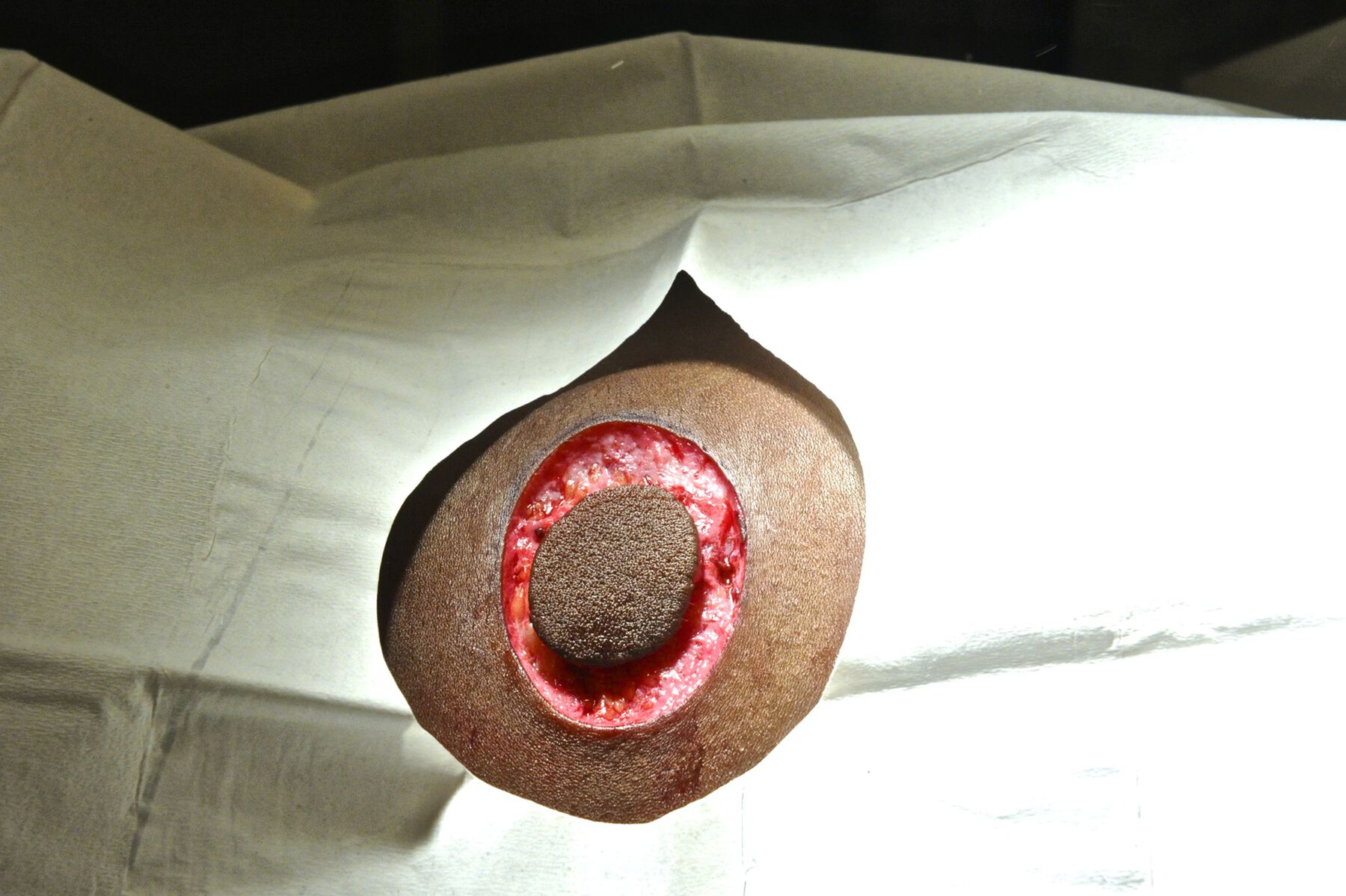 A close-up view of the artist's back after a portion of skin was removed