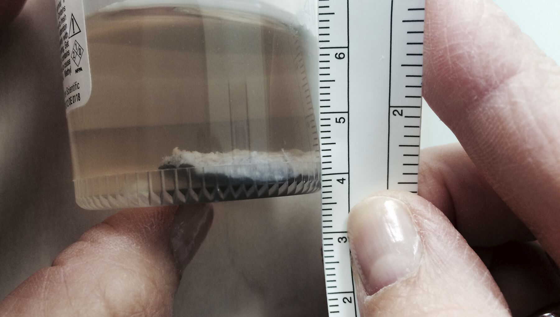 A container that holds the removed skin floating in liquid is measured with a ruler