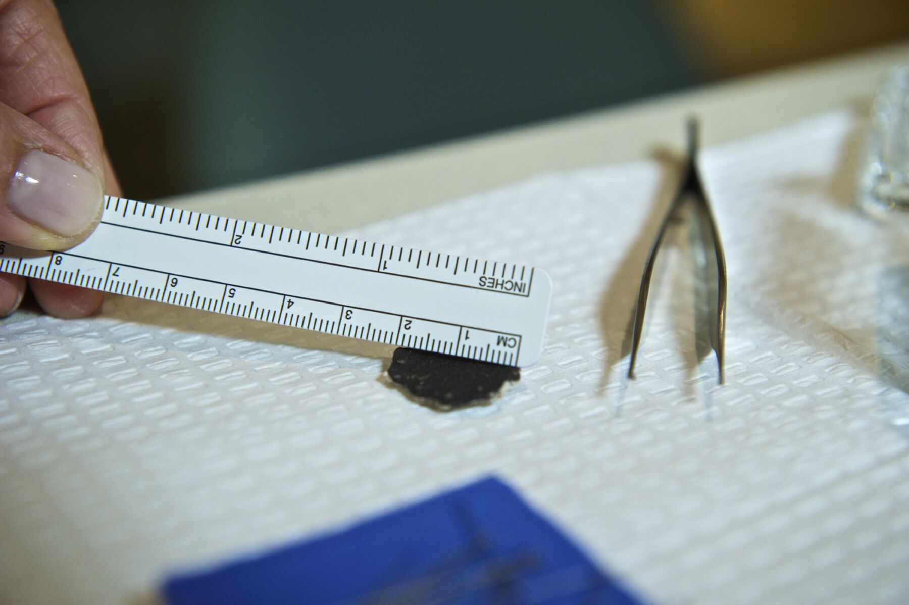 Fingers hold a ruler over the dried-up brown skin with tweezers on the side