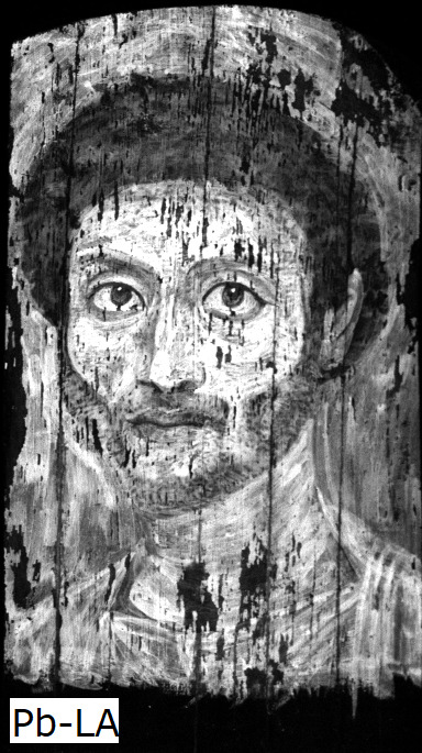 Grayscale image of the portrait of a man indicating in bright white the presence of lead across the man's face, neck, and clothing. His hair appears in black.