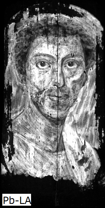 Grayscale image of the portrait of a man indicating in bright white the presence of lead across the man's face, neck, and clothing.