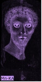 Portrait of a man in which the contour of the face and facial features appears in purple indicating the presence of manganese in these areas. His entire face and neck are shaded in purple. The background and are below the neck are dark.