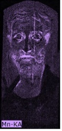 Portrait of a man with purple areas around the eyes, ears, and lips indicating the presence of manganese.
