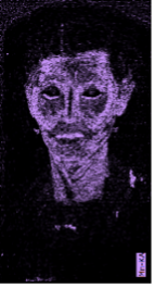 Portrait of an individual where the entire face is colored in bright purple indicating the high presence of manganese.