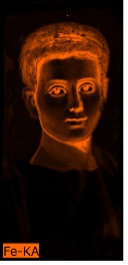 Portrait of a child where the outline of the hair, the contour of the facial features, and the area underneath the chin appear in bright orange indicating the presence of iron pigments.