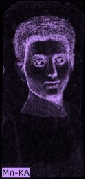 Portrait of a child where the hair, outline of the hair, the contour of the facial features, and the area underneath the chin appear in purple indicating the presence of manganese.
