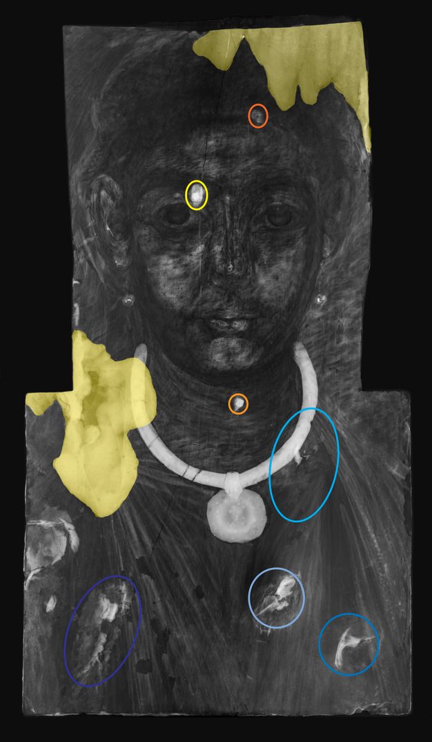 Black and white X-radiograph image of a mummy portrait. The image is annotated with various yellow, orange, blue, and purple circles indicating interventions to the portrait completed in the past along the neck, chest, and face of the invidual. Areas shaded in yellow on the upper right corner of the portrait and on the individual's right shoulder indicate modern interventions.